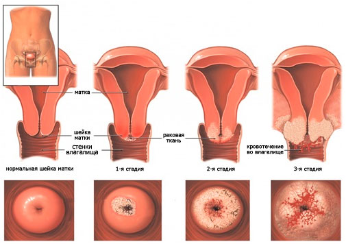 Лечение рака шейки матки 1-й стадии